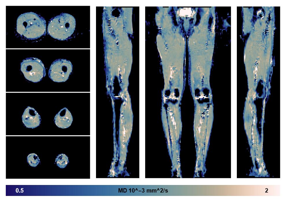 IVIM corrected whole leg muscle mean diffusivity obtained from diffusion tensor imaging.